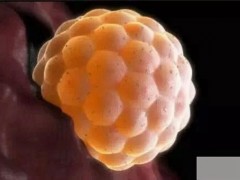 多囊和多囊卵巢综合征是一种症状吗？多囊和多囊卵巢综合征它们的区别是什么