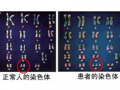 为什么染色染异常患者是选择做第三代试管婴儿？