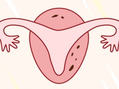 左側卵巢囊腫影響懷孕嗎？有左側卵巢囊腫可