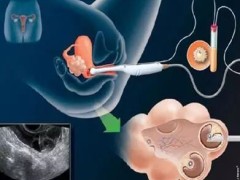 第几代试管可选择性别?费用需要多少？