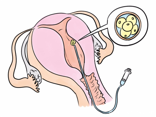 试管移植成功后哪些食物不能吃？试管促排取卵期间饮食原则